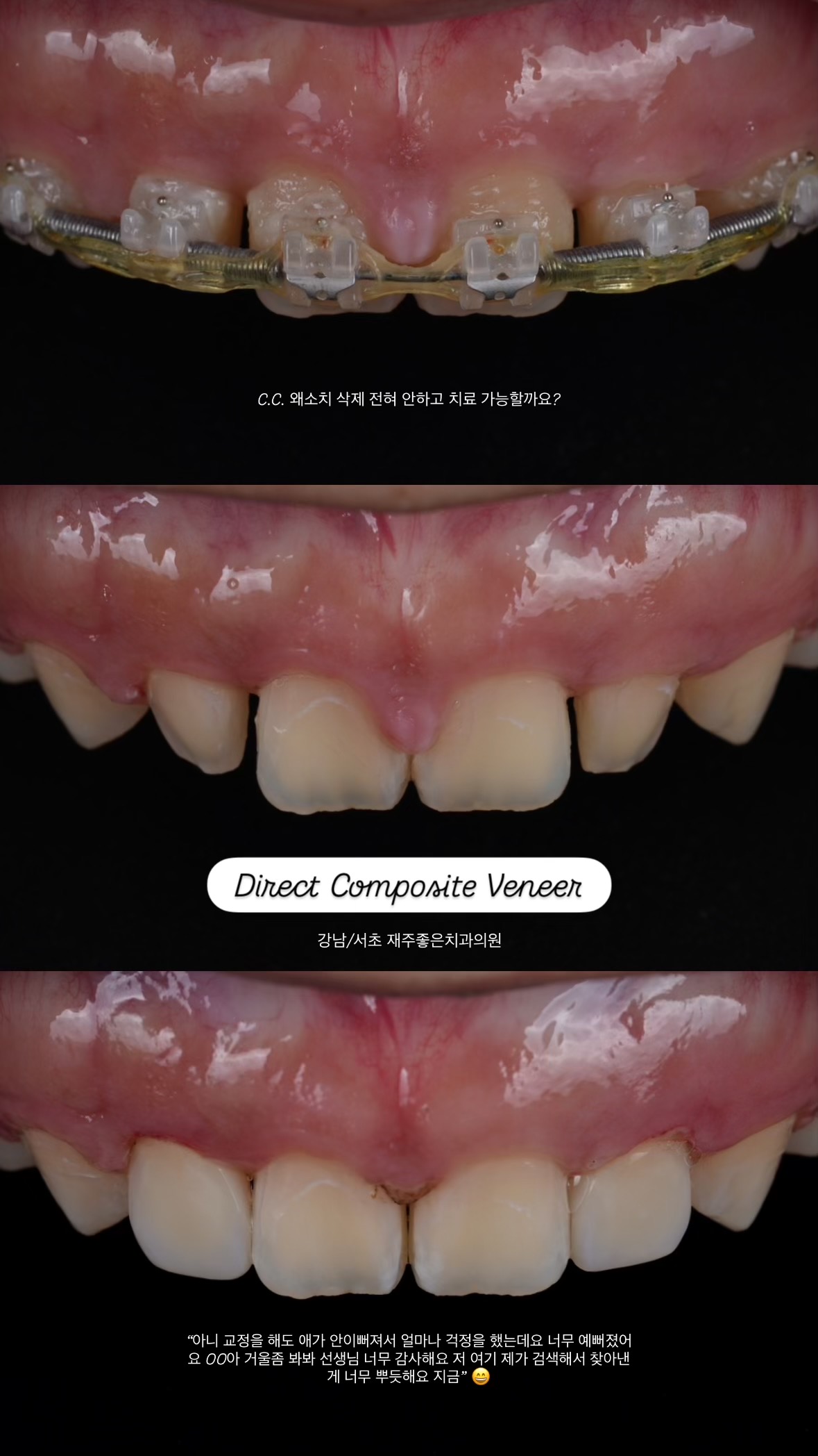 왜소치 교정 후 레진비니어로 치료한 사진. "교정을 해도 애가 안이뻐져서 얼마나 걱정을 했는데요, 너무 예뻐졌어요" 후기