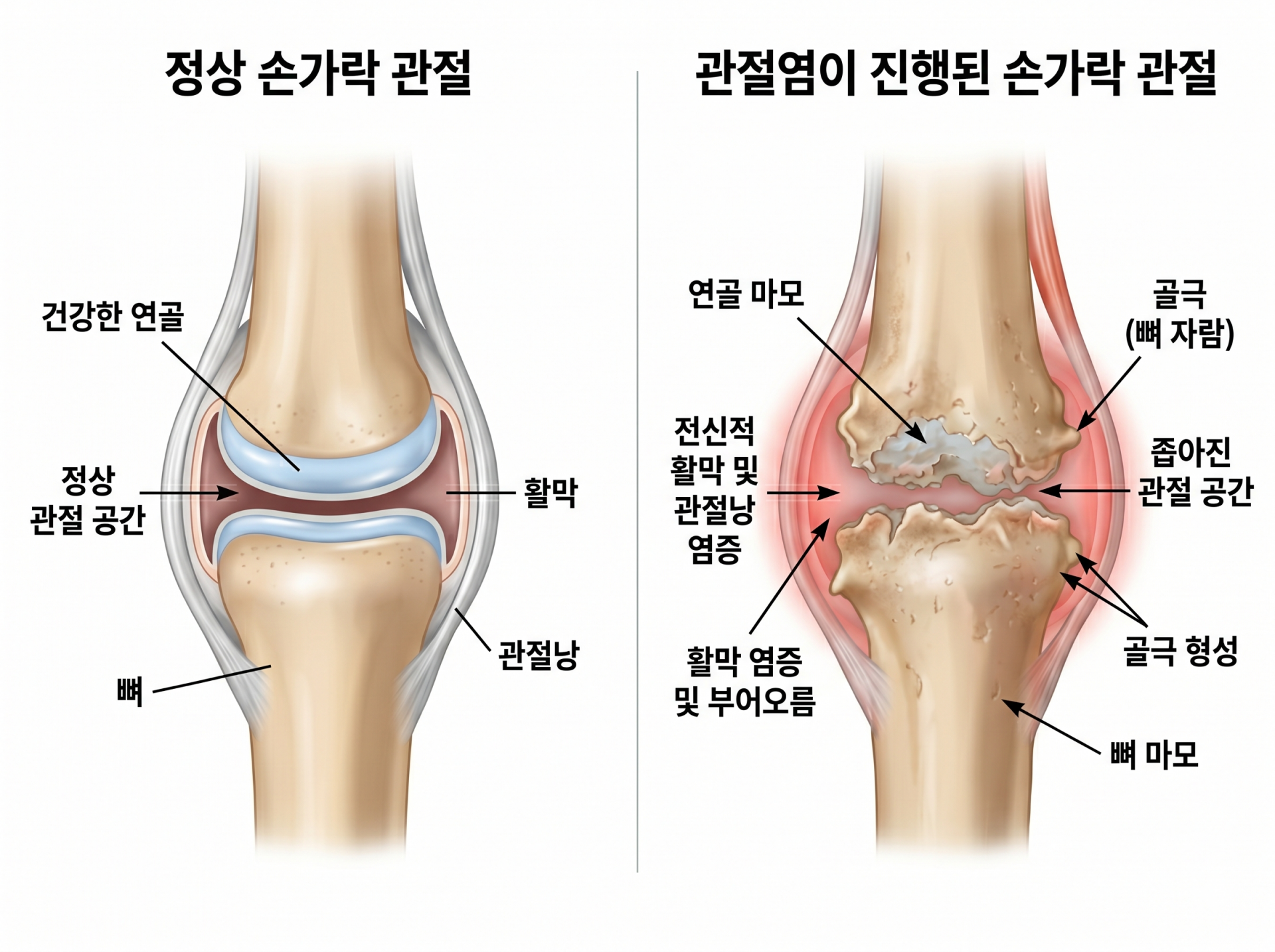 정상 손가락 관절과 손가락관절염 관절을 비교한 의료 일러스트