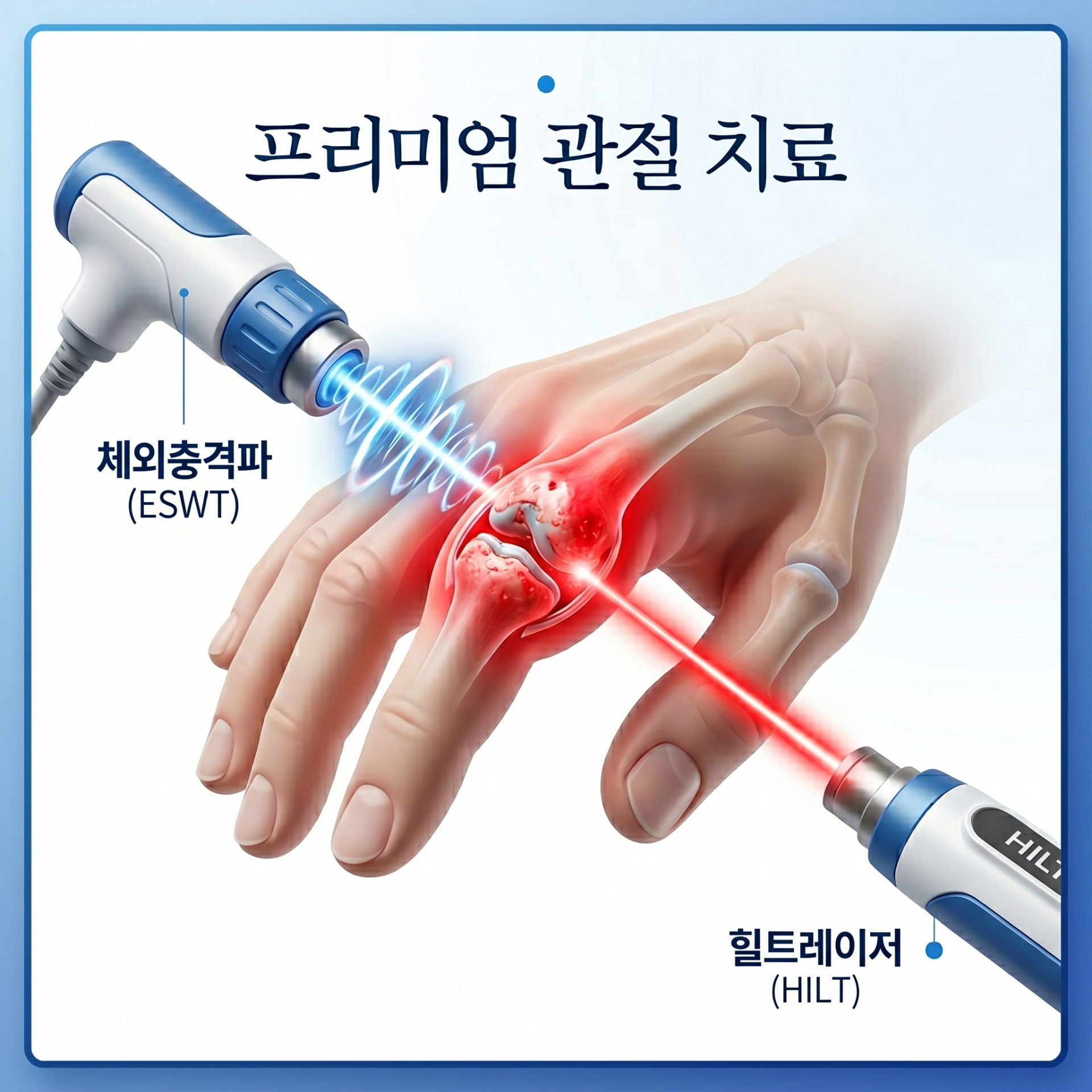 finger-arthritis-treatment-shockwave-hilt-laser.webp.png