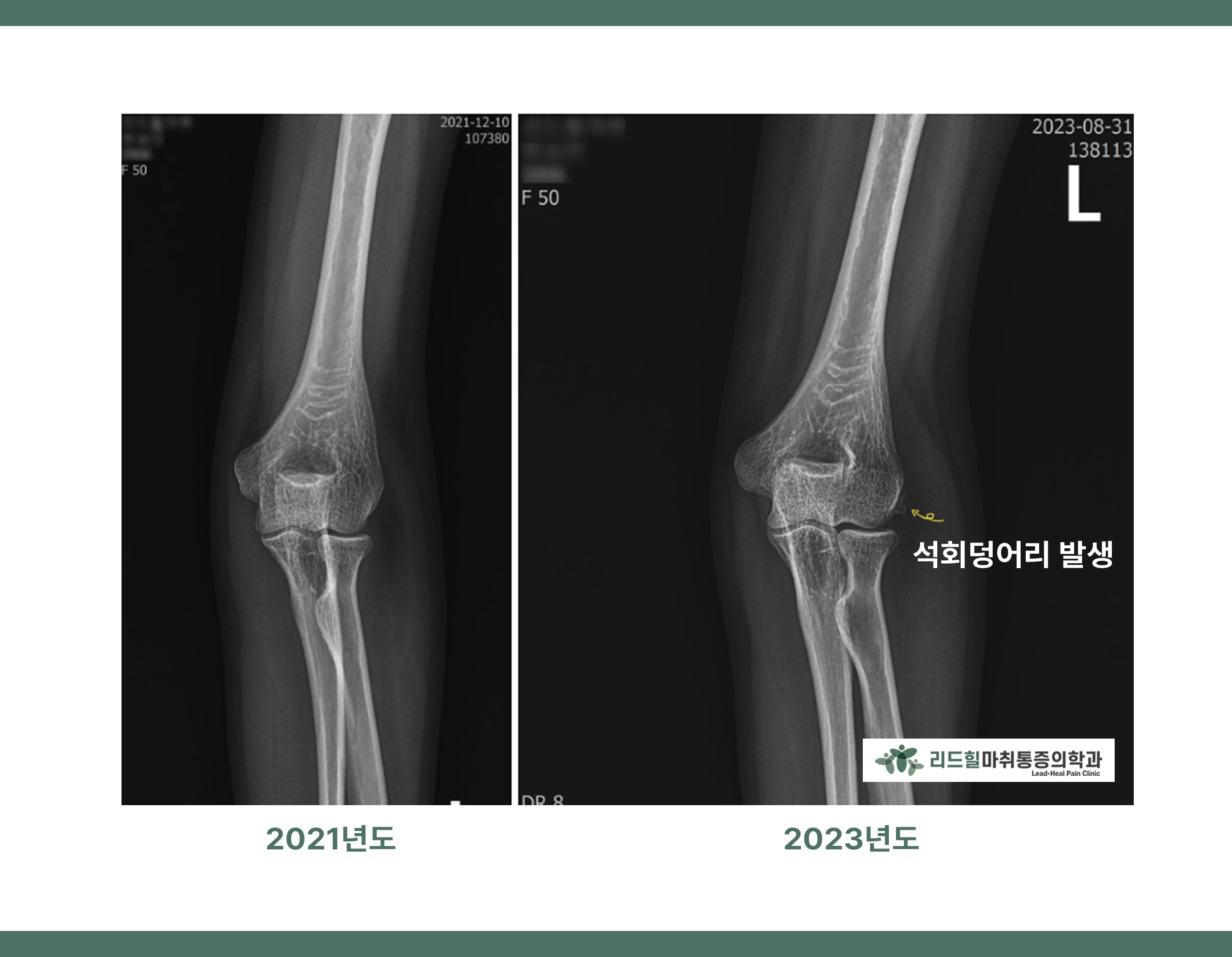 석회성건염 치료: 체외충격파(ESWT)로 석회 제거가 가능할까? : 리드힐마취통증의학과 건강관리팁