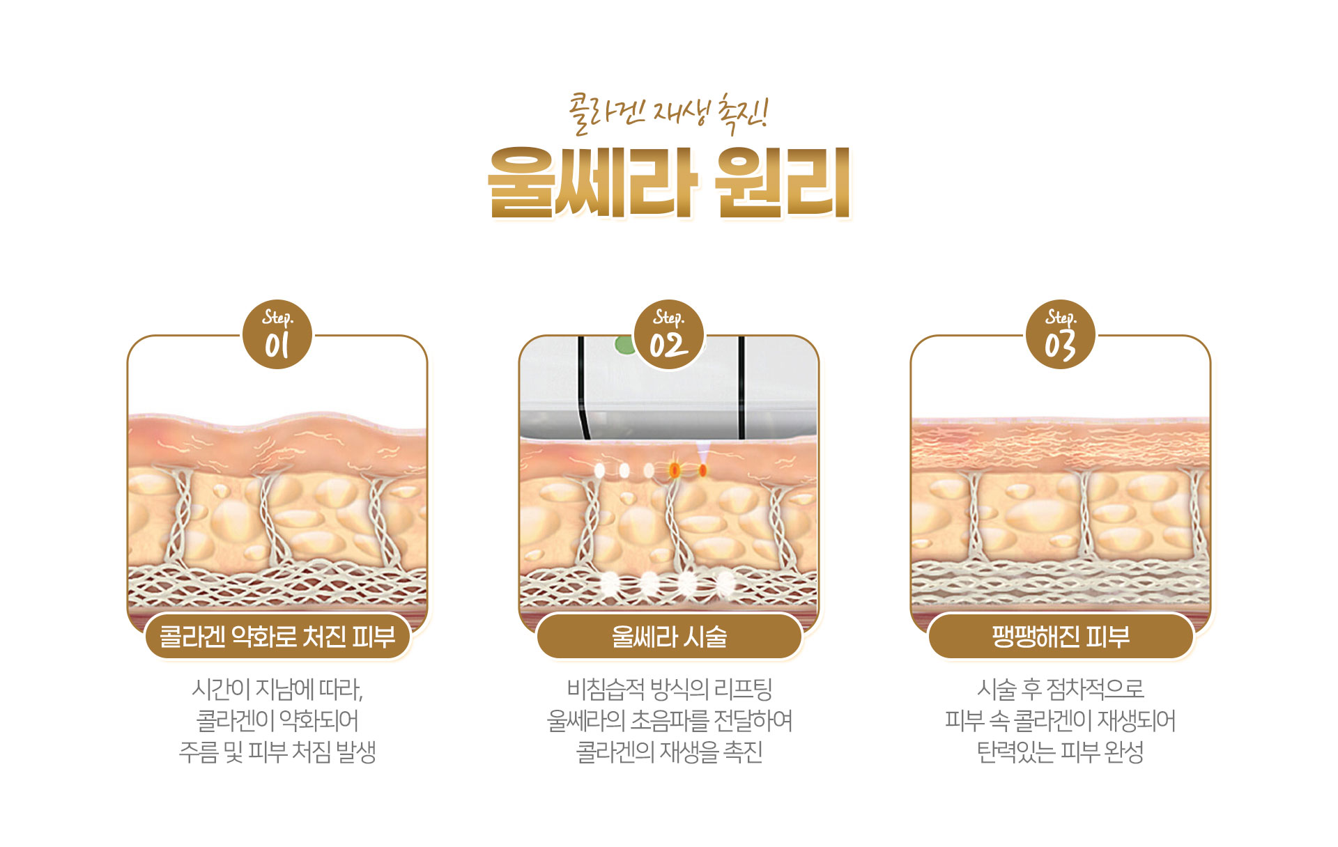 울쎄라 효과 명동피부과 닥터에버스 울쎄라 효과 명동피부과 닥터에버스