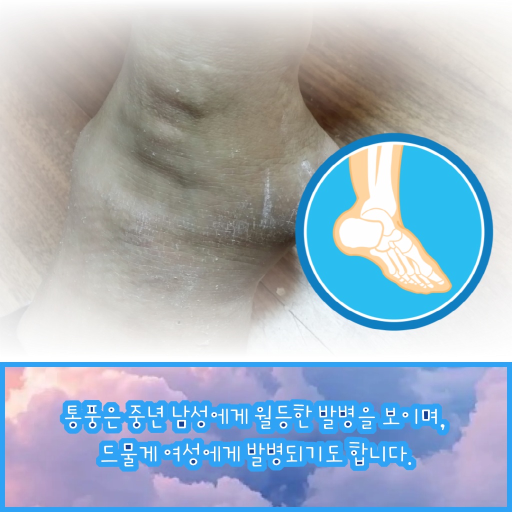 주로 중년 남성에게 발병하며 드물게 여성에게도 나타나는 통풍 설명 이미지