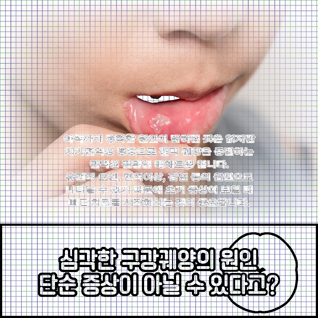 심각한 구강궤양이 단순한 증상이 아닐 수 있는 원인 설명 이미지