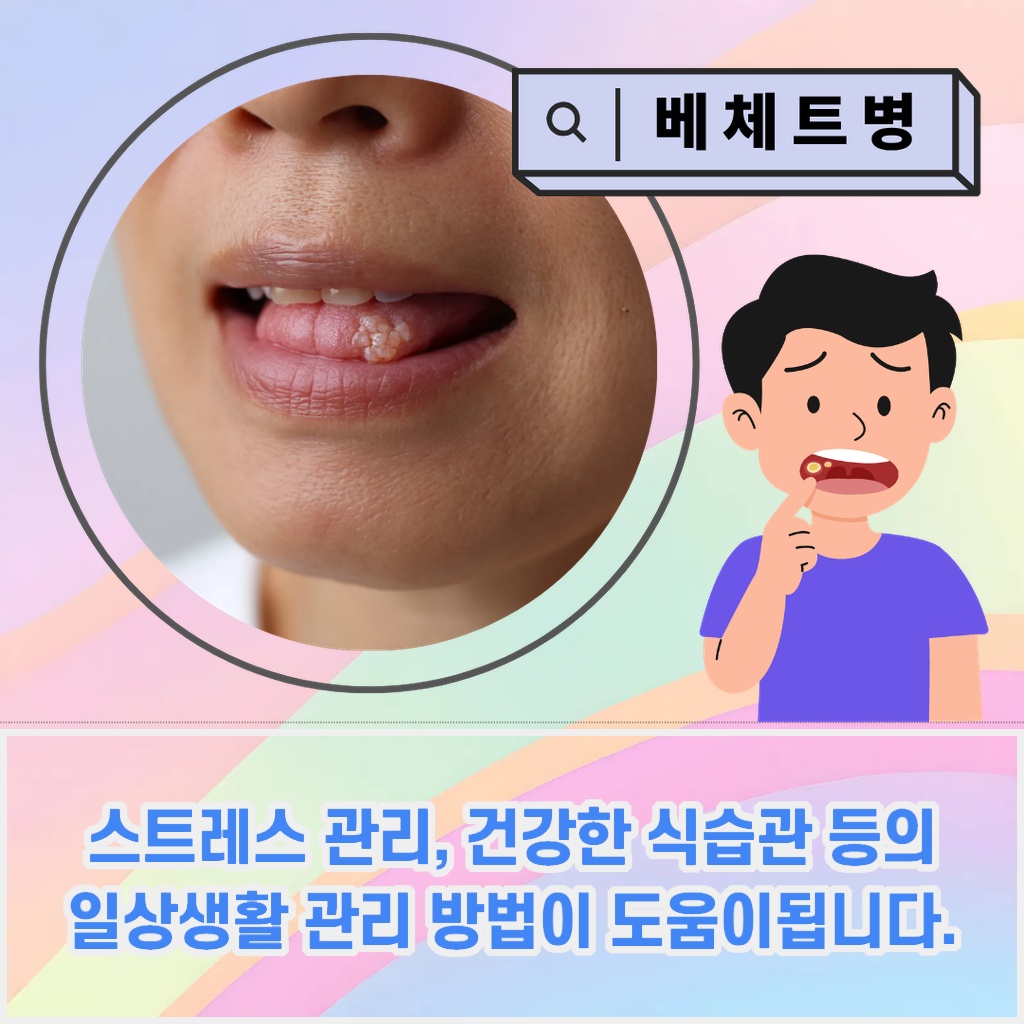 스트레스 관리와 건강한 식습관 등 일상생활 관리가 도움이 되는 베체트병 설명 이미지
