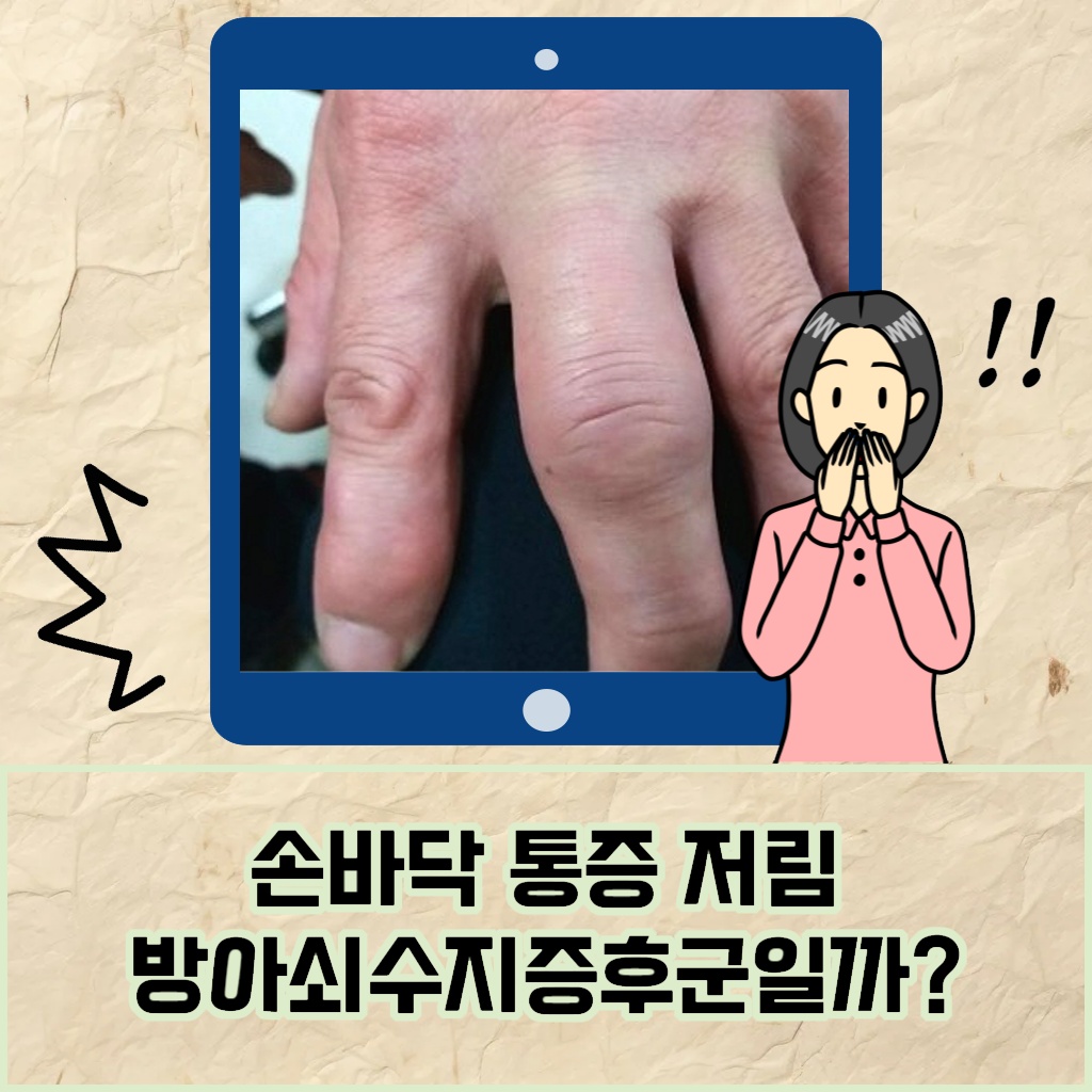 손바닥 통증과 저림을 유발하는 방아쇠수지증후군 설명 이미지.