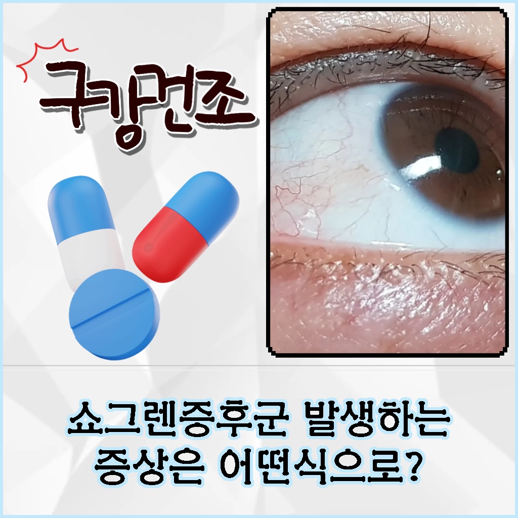 쇼그렌증후군으로 인해 발생하는 증상 설명 이미지