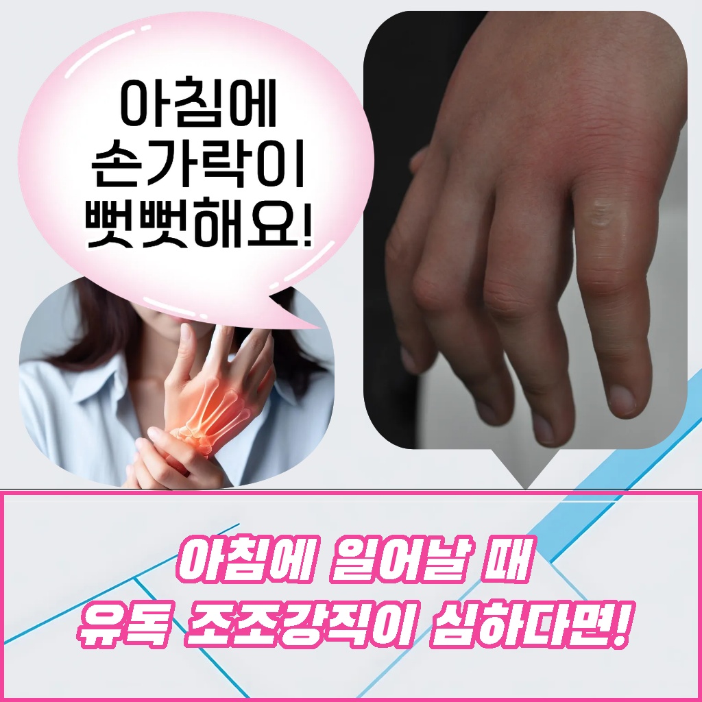 아침에 일어날 때 유독 손가락이 뻣뻣해지는 조조강직 증상 설명 이미지