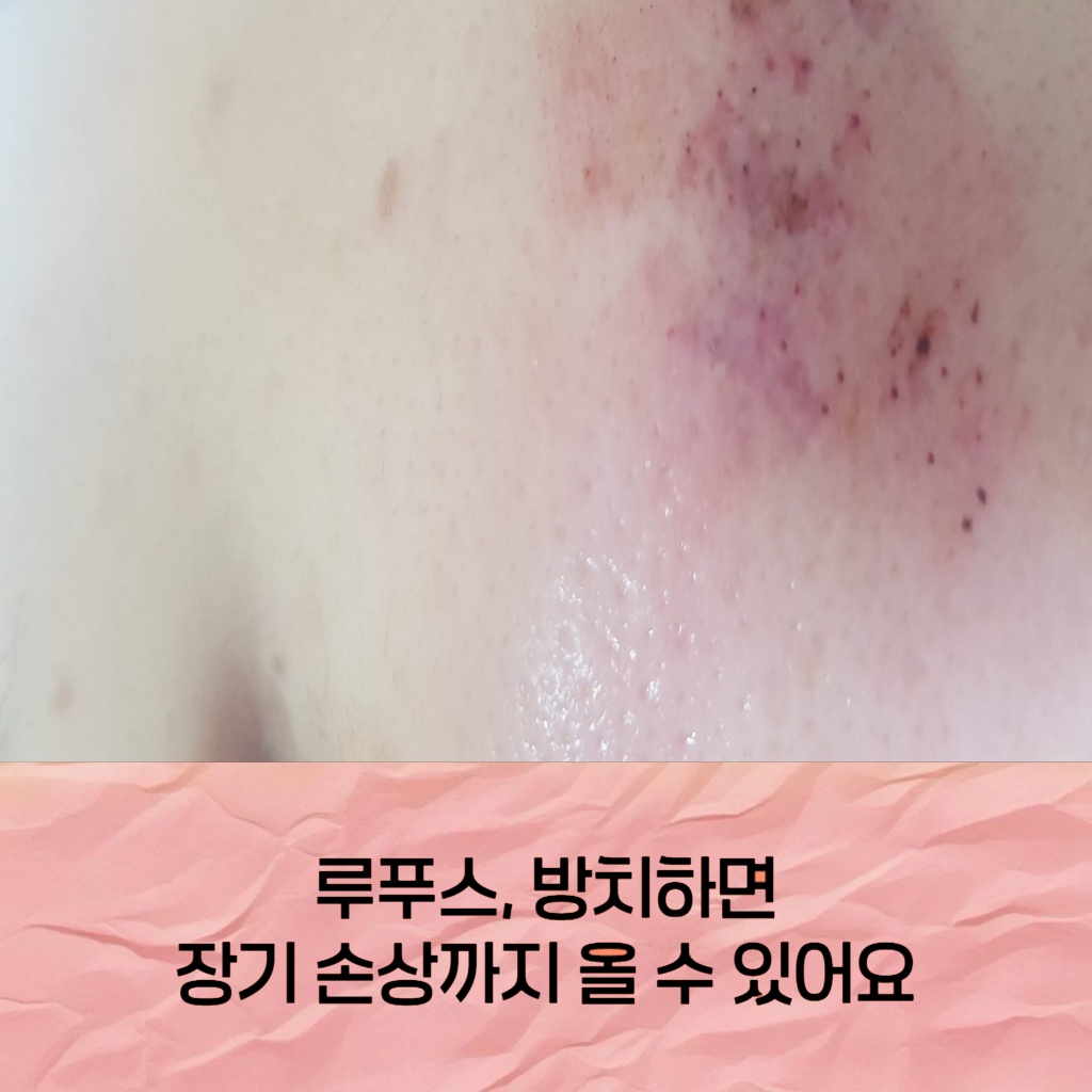 루푸스를 방치하면 장기 손상까지 유발할 수 있음을 알리는 설명 이미지