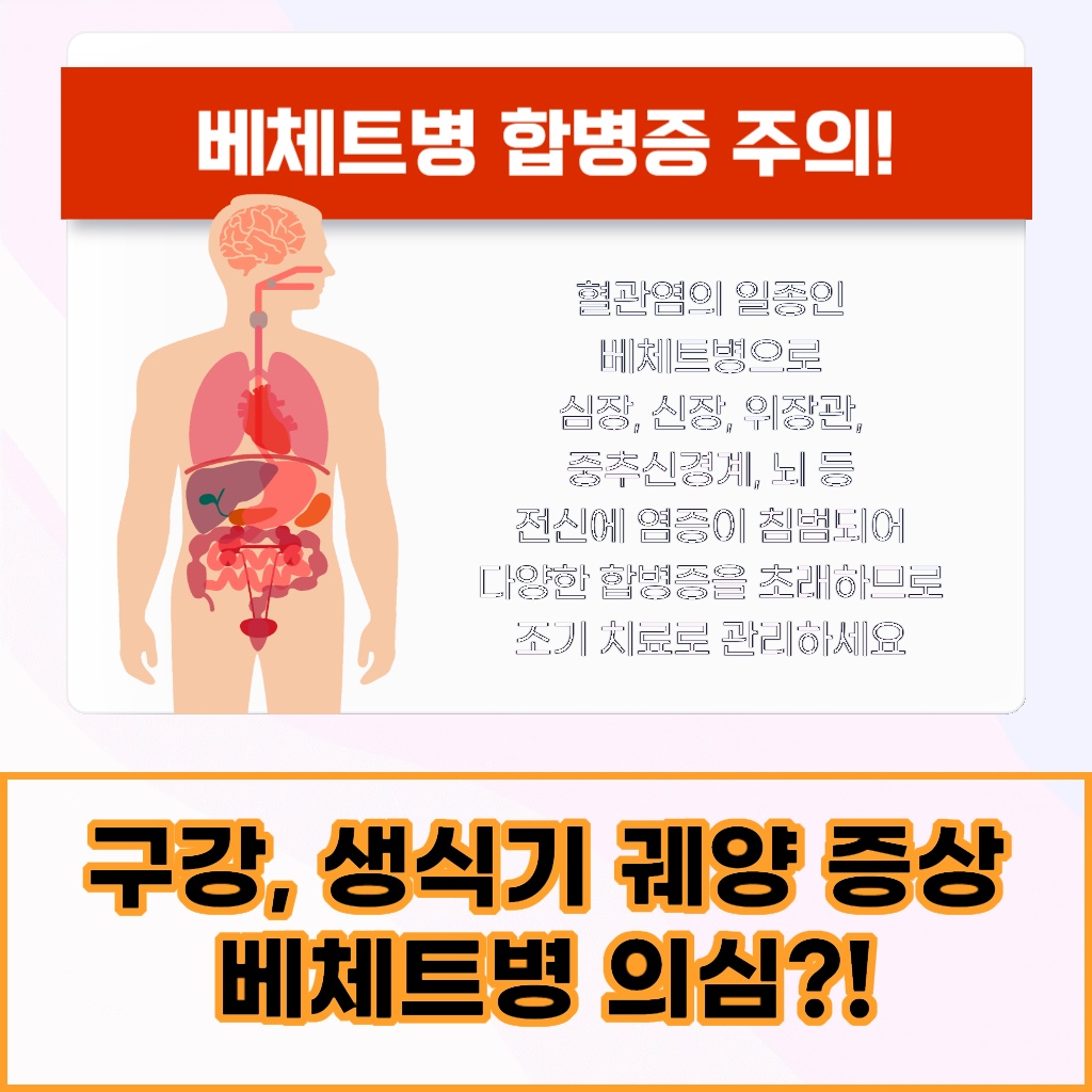 구강과 생식기에 궤양 증상이 나타날 때 베체트병을 의심할 수 있음을 나타내는 설명 이미지