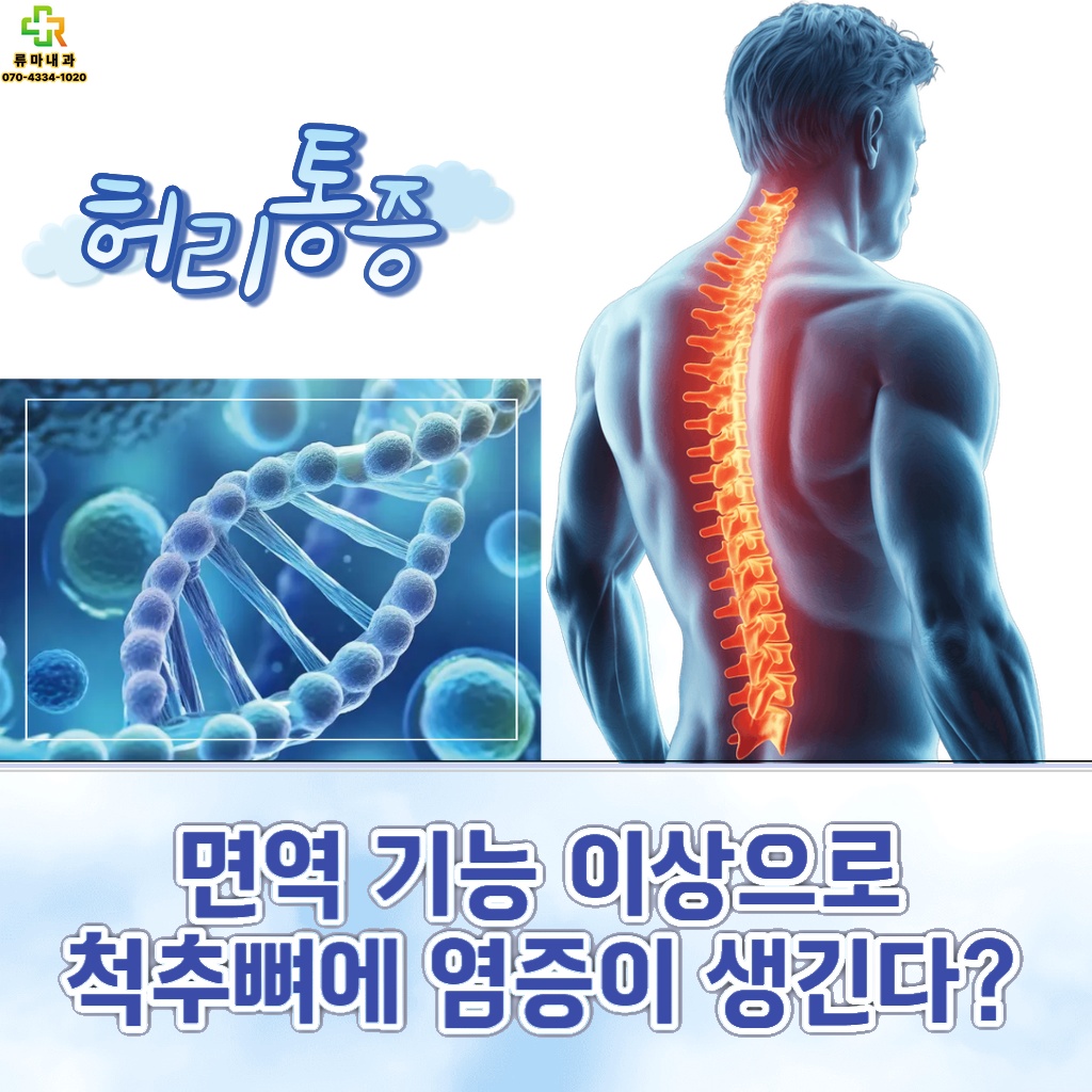 면역 기능 이상으로 척추뼈에 염증이 발생하는 설명 이미지