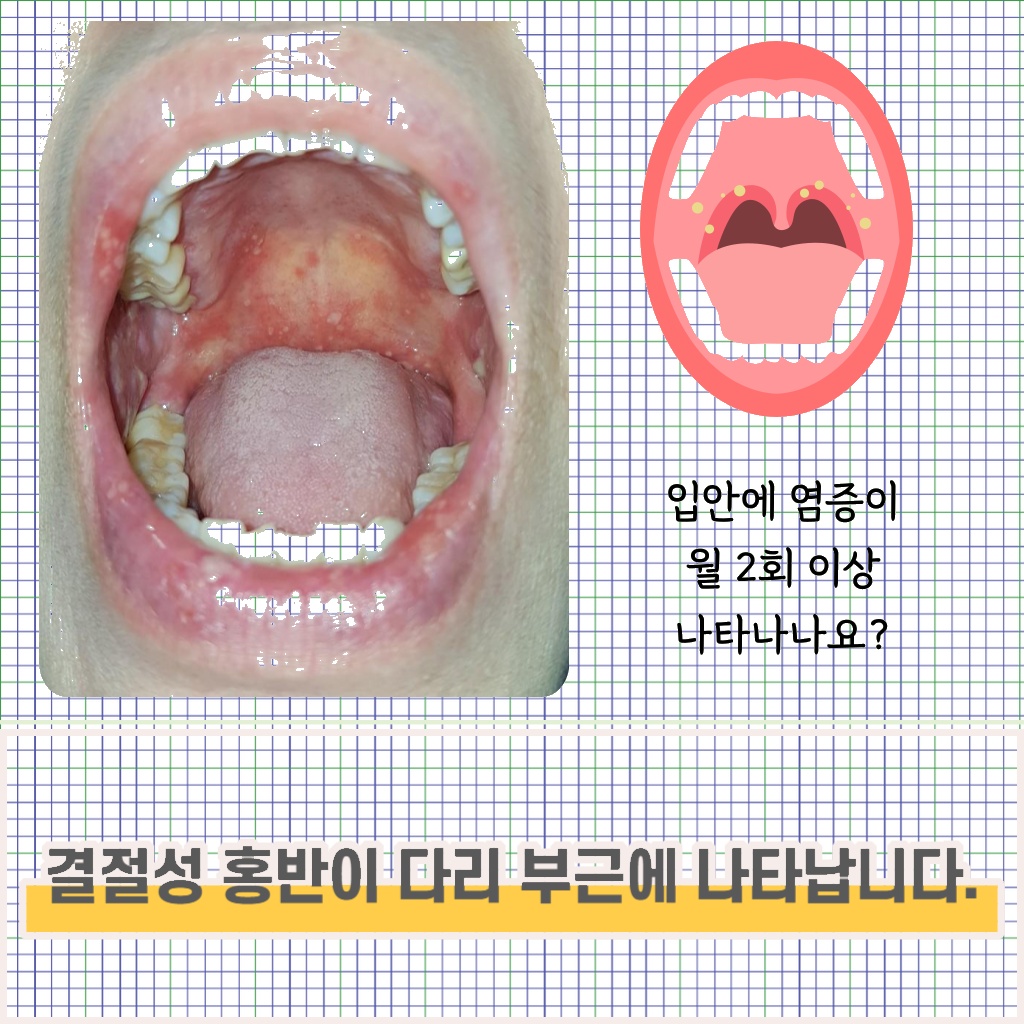 다리 부근에 결절성 홍반이 나타나는 설명 이미지