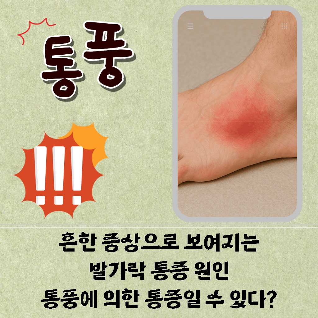흔한 증상으로 나타나는 발가락 통증의 원인이 통풍일 수 있다는 설명 이미지.