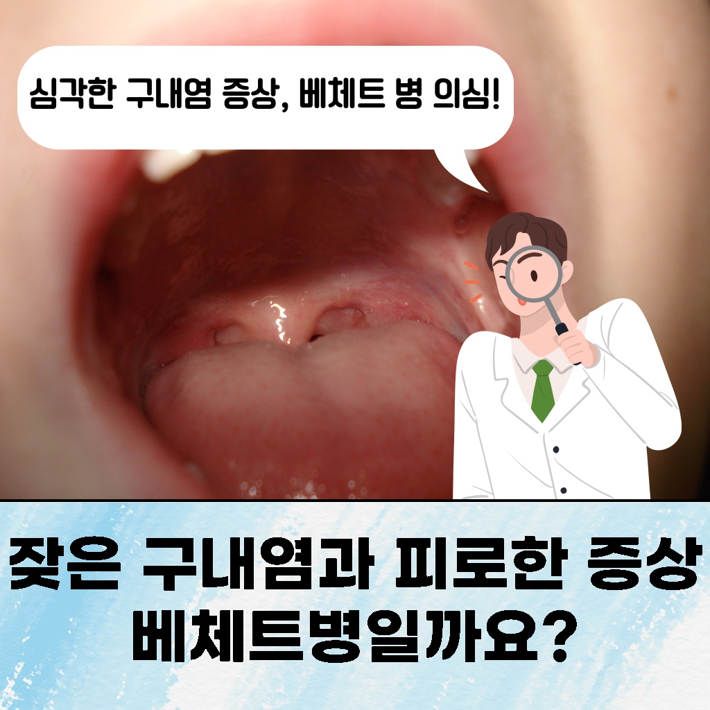 잦은 구내염과 피로 증상을 동반하는 베체트병 설명 이미지