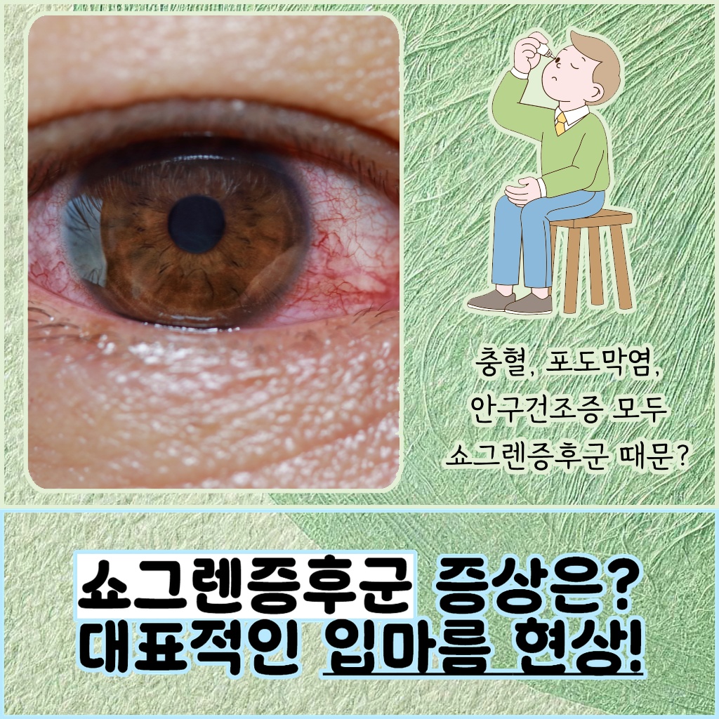 쇼그렌증후군의 대표적인 증상인 입마름 현상 설명 이미지