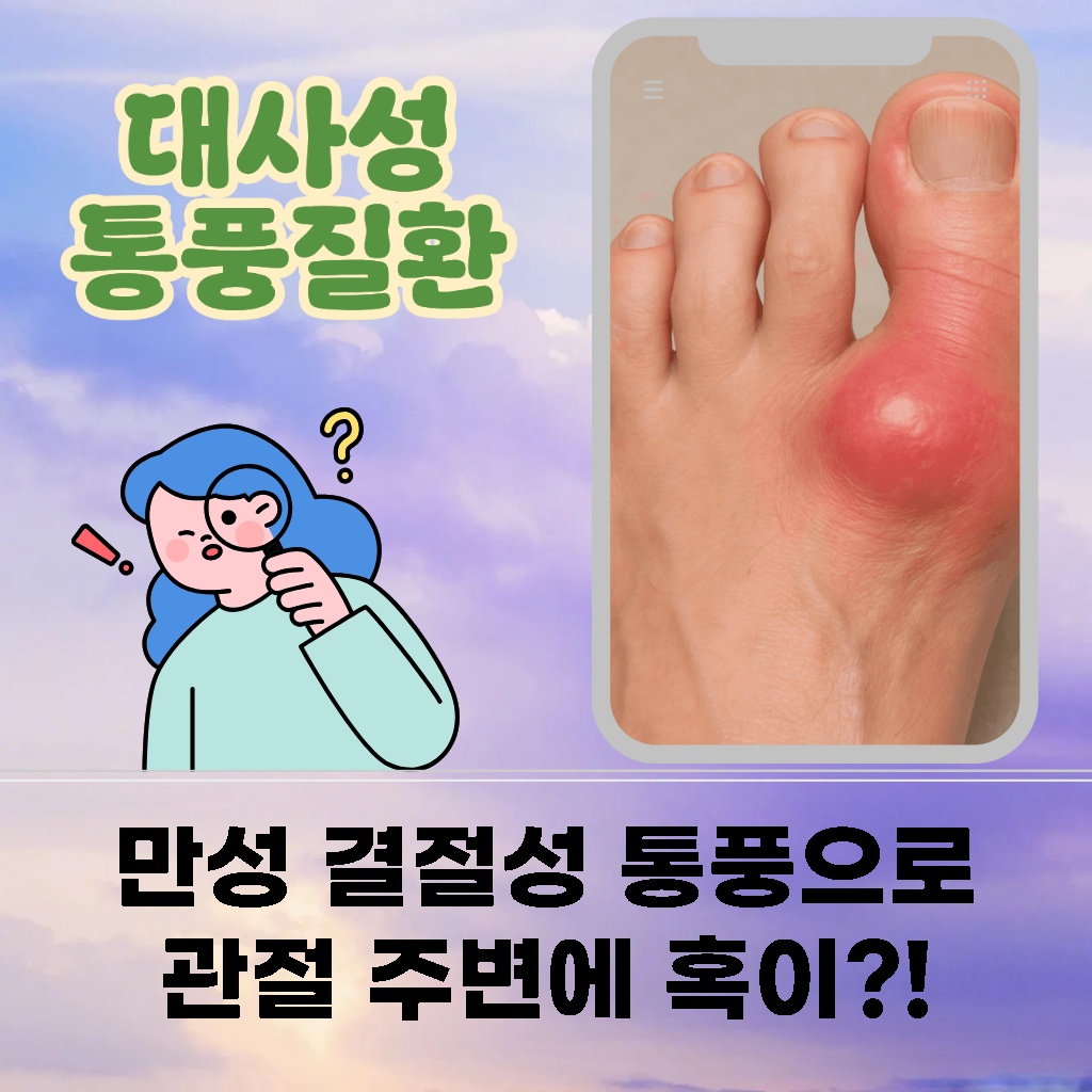 만성 결절성 통풍으로 관절 주변에 생긴 혹 설명 이미지