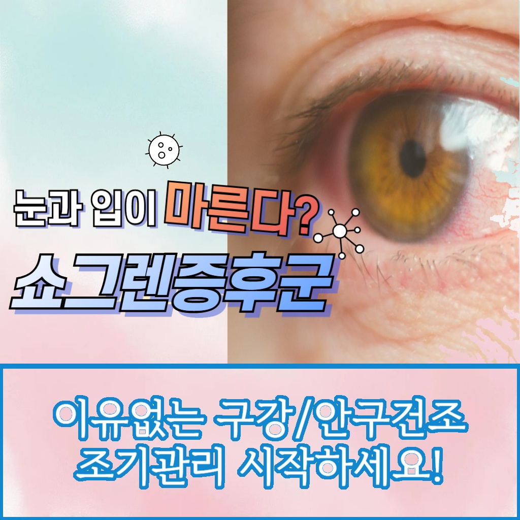이유 없는 구강 및 안구 건조를 유발하는 쇼그렌증후군의 조기 관리를 권장하는 설명 이미지