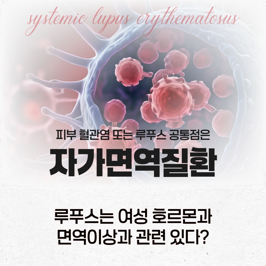 여성 호르몬 및 면역 이상과 관련이 있는 자가면역질환인 루푸스 설명 이미지