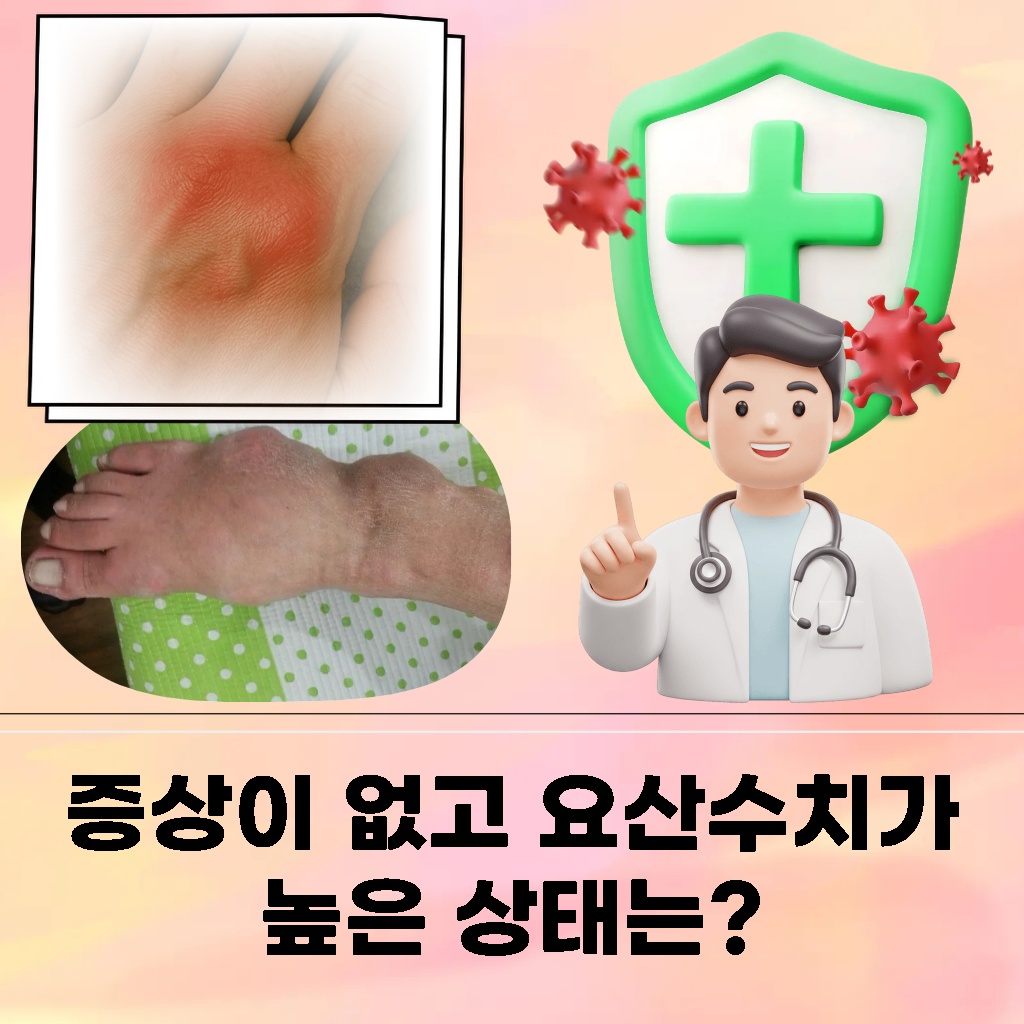 증상은 없지만 요산수치가 높은 상태 설명 이미지