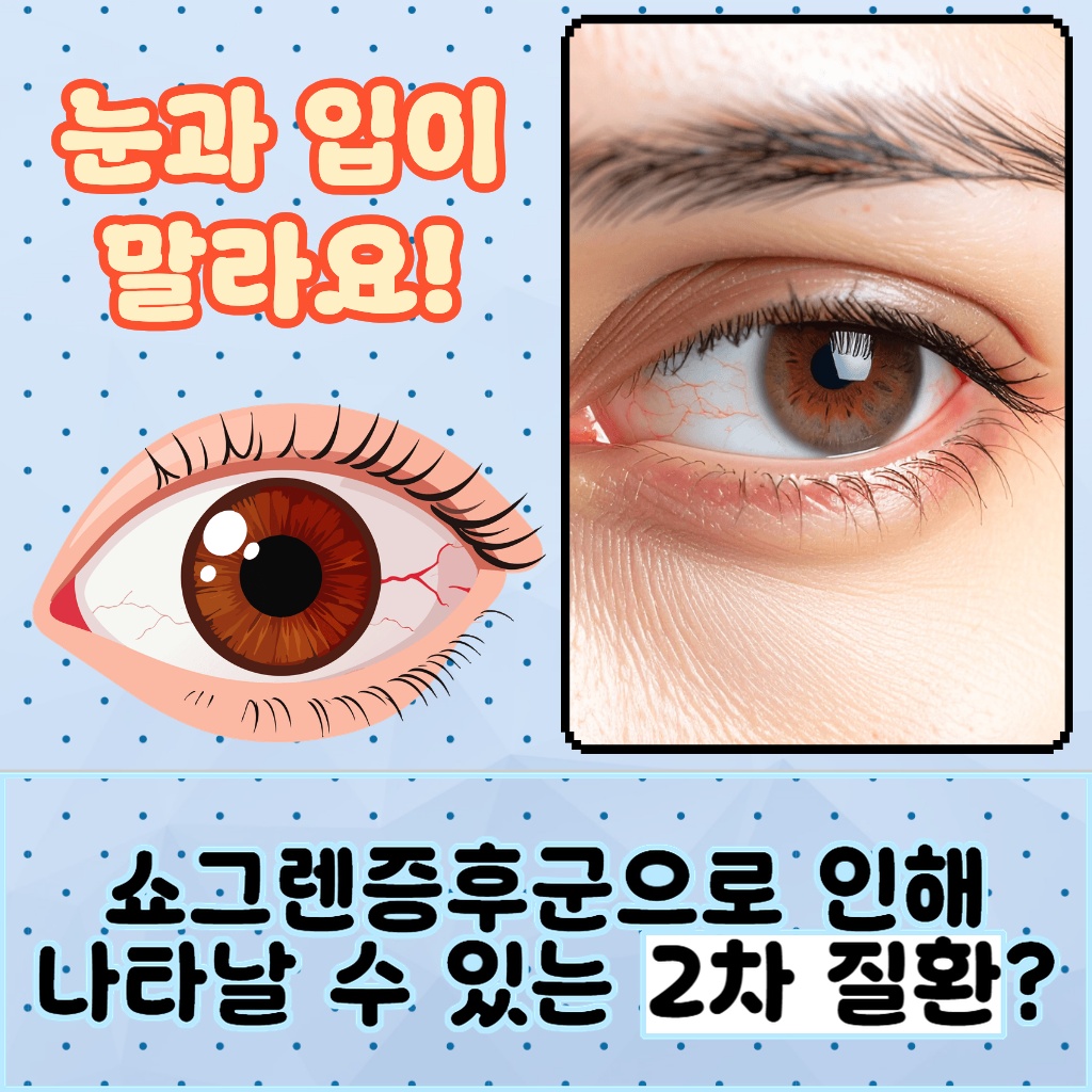 쇼그렌증후군으로 인해 나타날 수 있는 2차 질환 설명 이미지