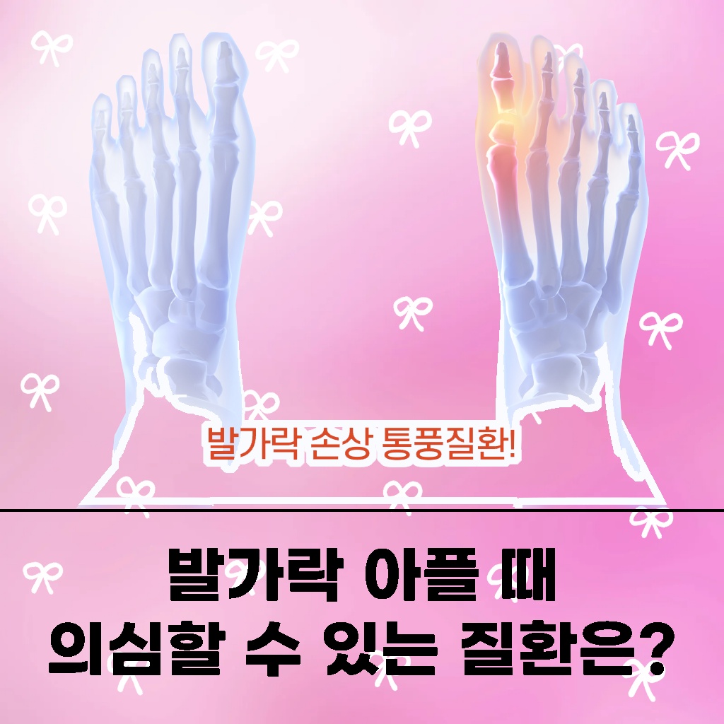 발가락이 아플 때 의심할 수 있는 통풍 질환 설명 이미지