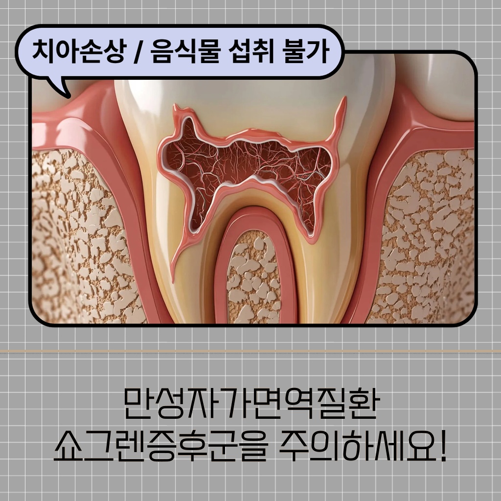 만성 자가면역질환인 쇼그렌증후군에 대해 주의를 당부하는 설명 이미지