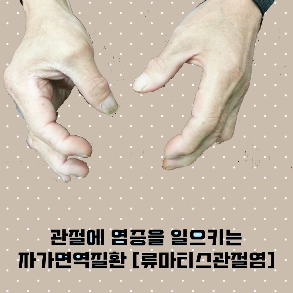 관절에 염증을 일으키는 자가면역질환인 류마티스관절염 설명 이미지