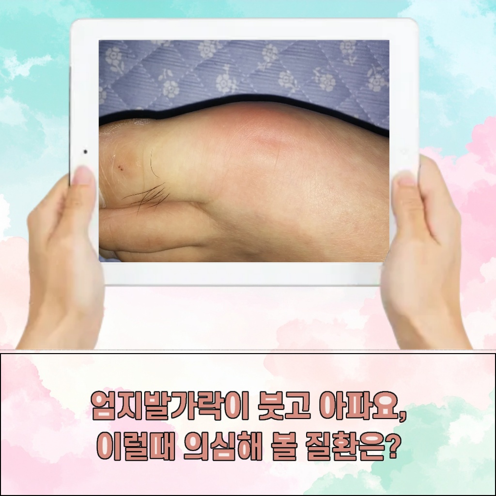 엄지발가락이 붓고 아플 때 의심해 볼 수 있는 질환 설명 이미지