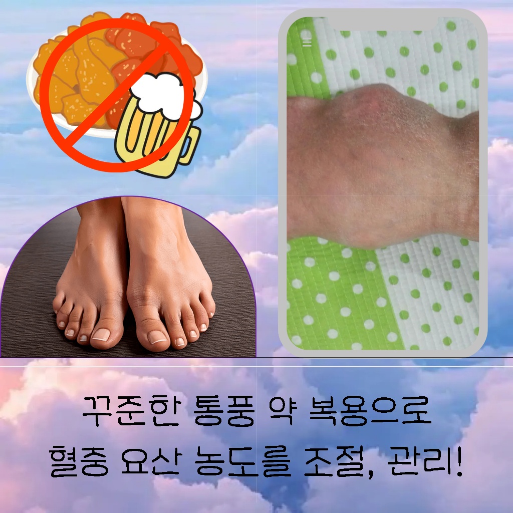 통풍 약을 꾸준히 복용하여 혈중 요산 농도를 조절하고 관리하는 설명 이미지