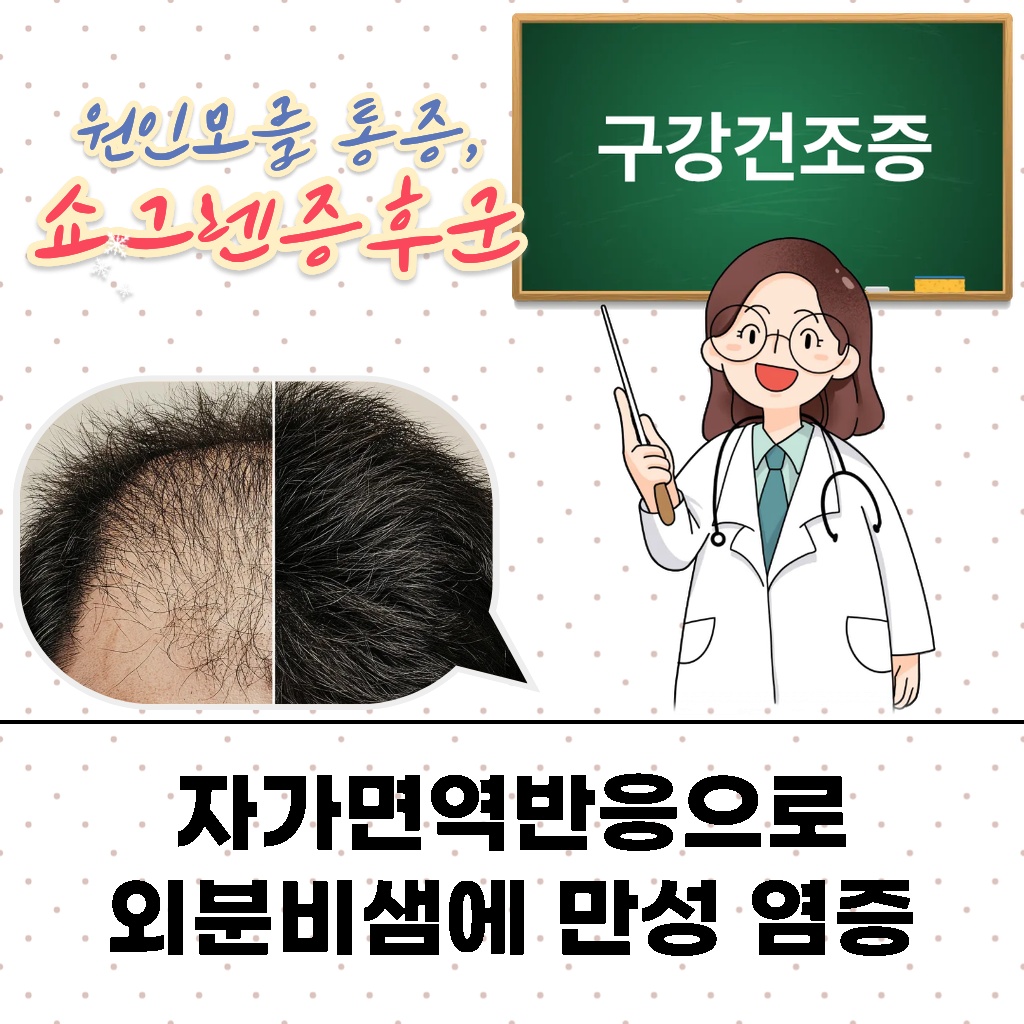 자가면역반응으로 외분비샘에 만성 염증이 발생하는 설명 이미지