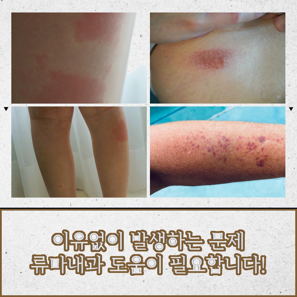 이유 없이 발생하는 문제로 류마내과의 도움이 필요하다는 설명 이미지