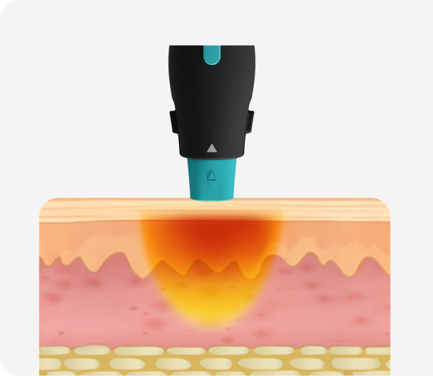 올리지오 Bulk Heating 피부 단면 인포그래픽