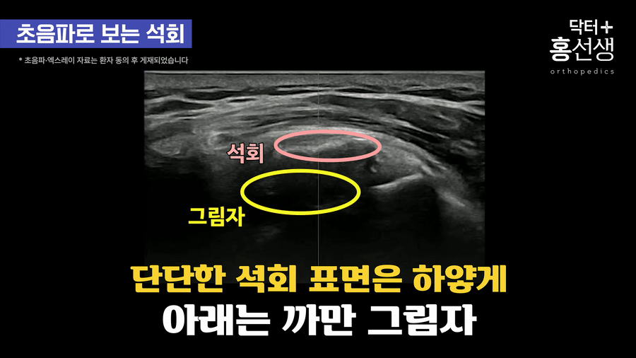 초음파가 통과하지 못해 그림자 생성