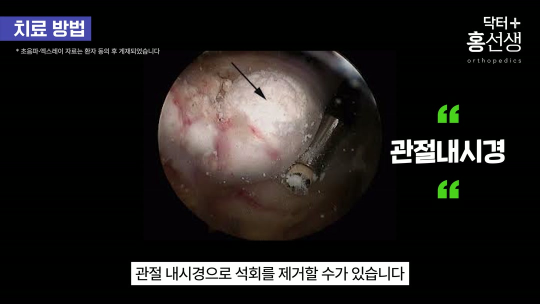 모든 석회를 수술하지 않는다는 강조