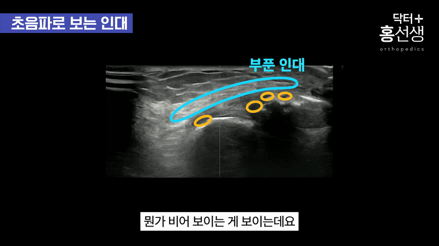 인대 내부 어두운 부분 확인