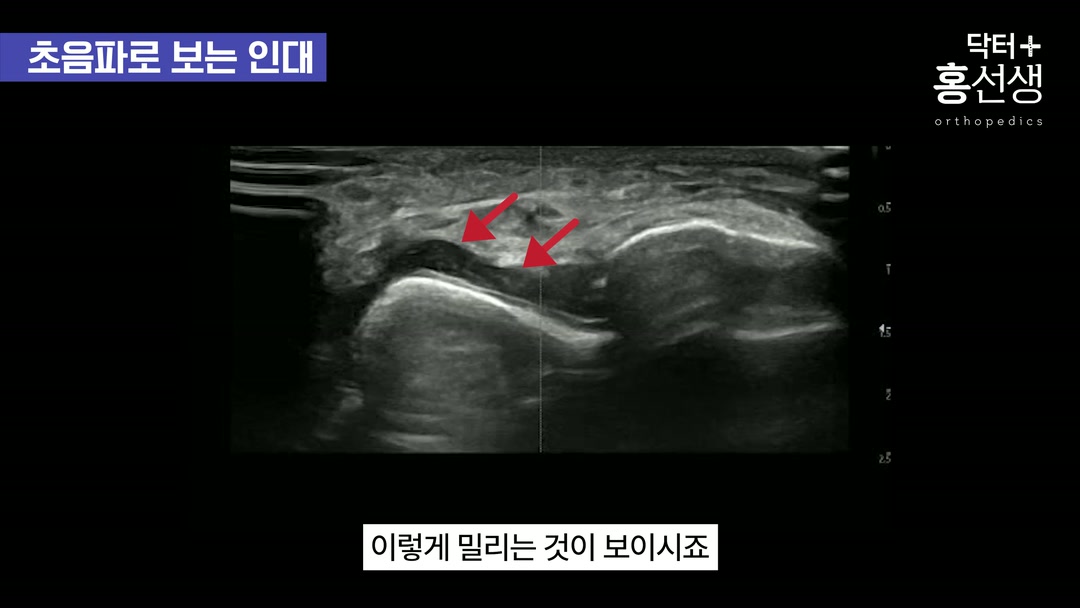 골절 동반 가능성 설명