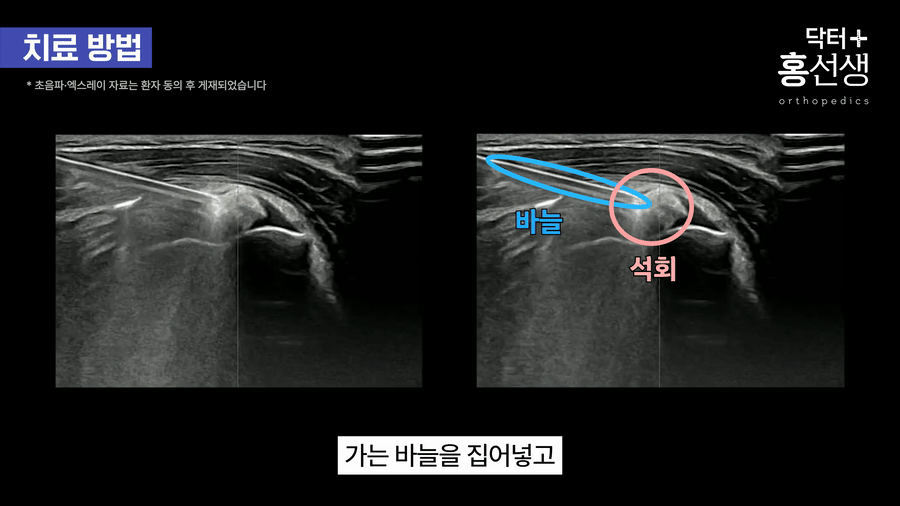 하얀 석회가 주사기로 나오는 모습