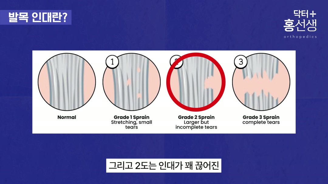 2도 부분 파열 설명