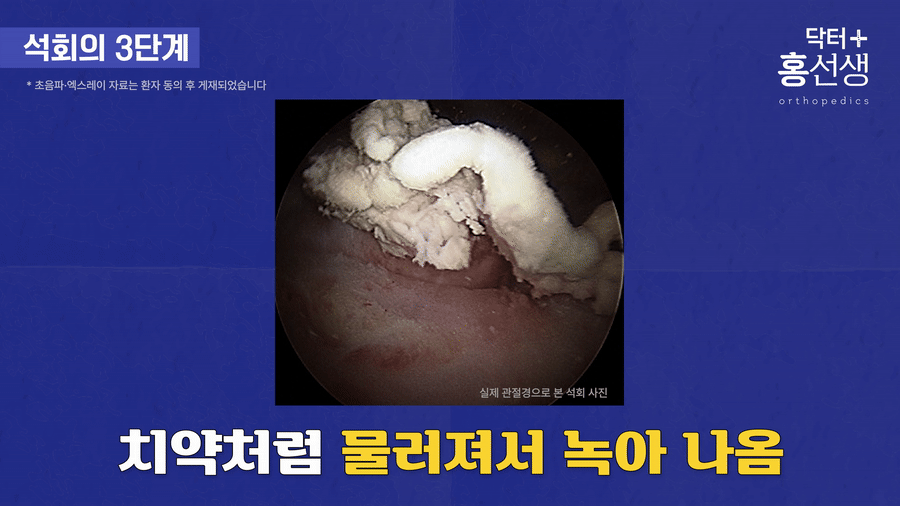 치약처럼 물러지는 석회 묘사