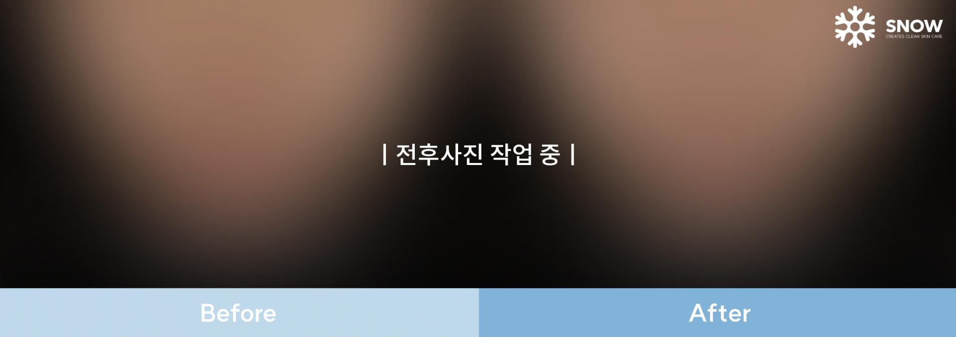 레이저 제모 전후 작업 이미지