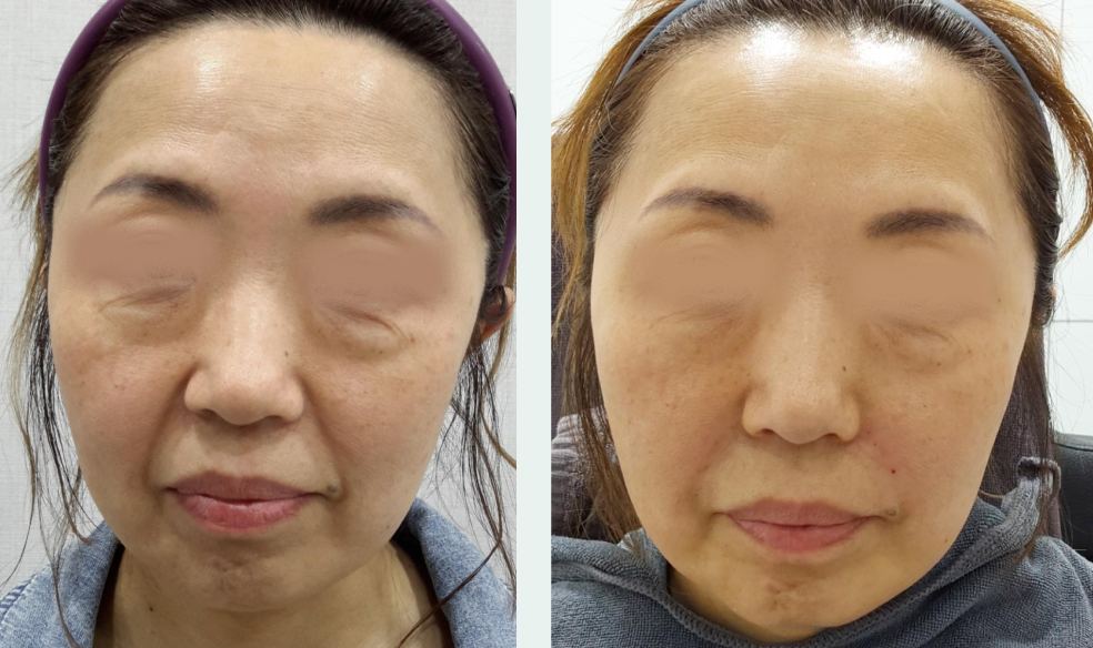 Nasolabial filler before/after 3