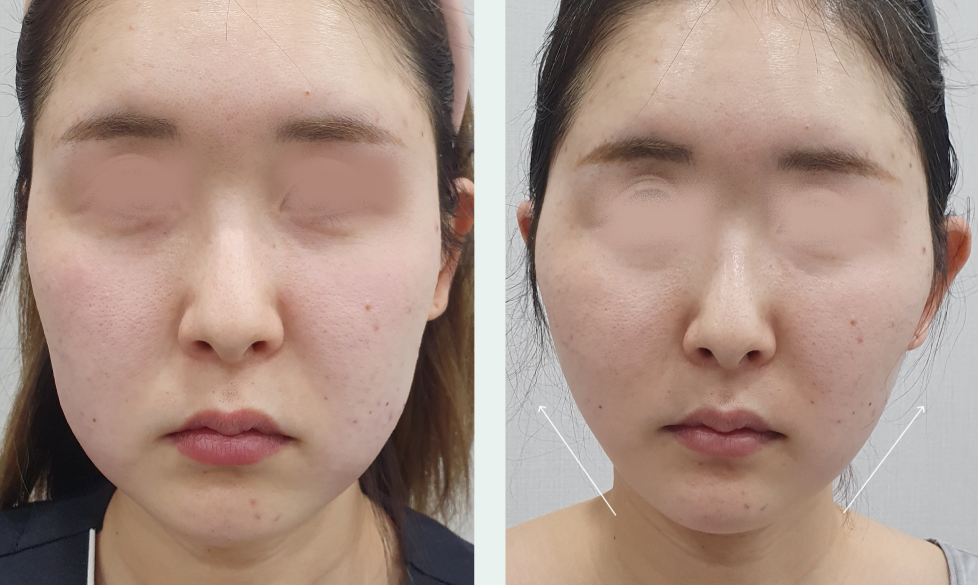 糸リフト ビフォーアフター 1