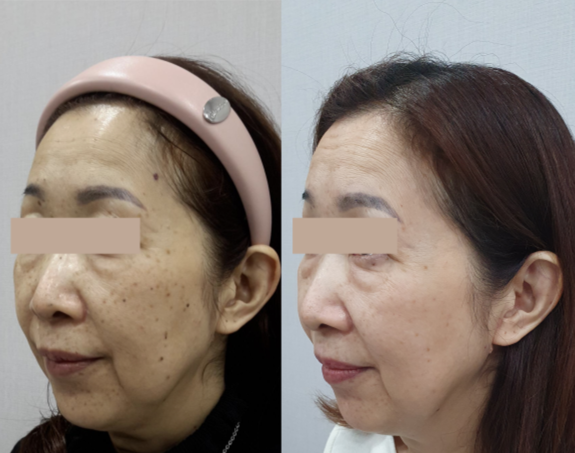 점·색소 레이저 치료 전후 사례 2