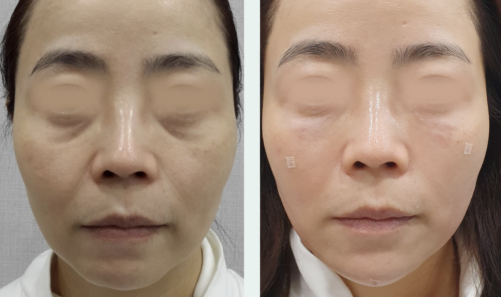 Under-eye filler before/after 2