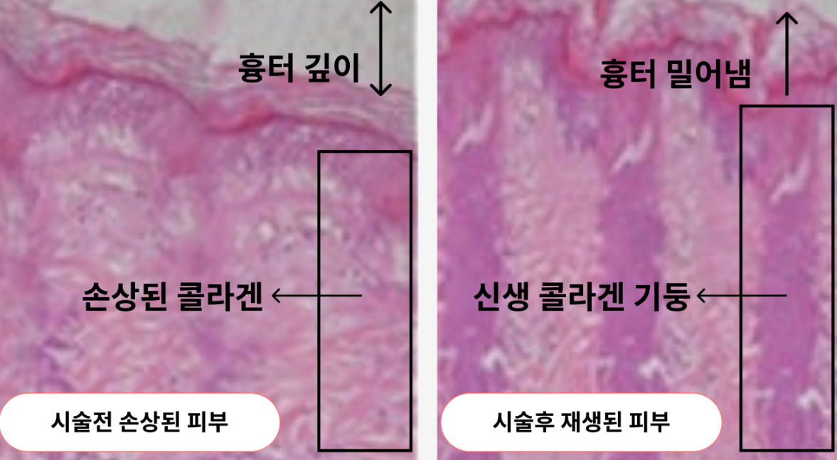 진피층 변화 참고