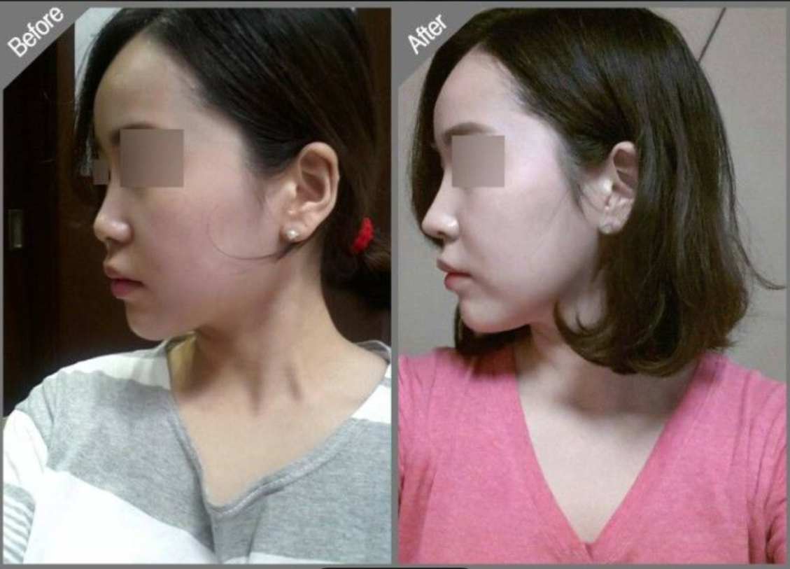 코 실리프팅 전후 1