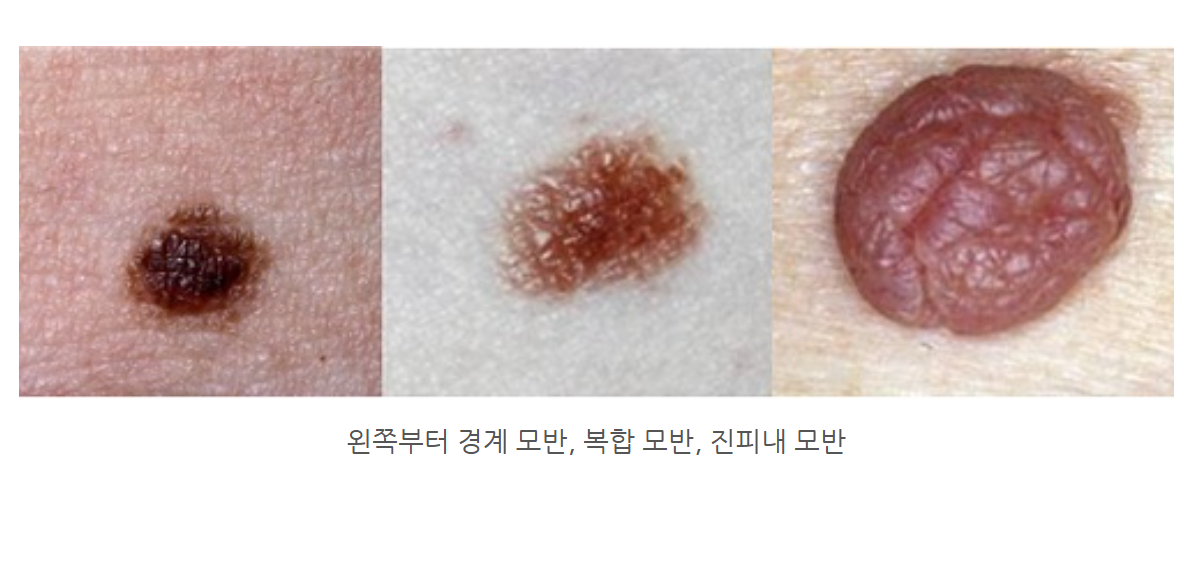 경계 모반, 복합 모반, 진피내 모반