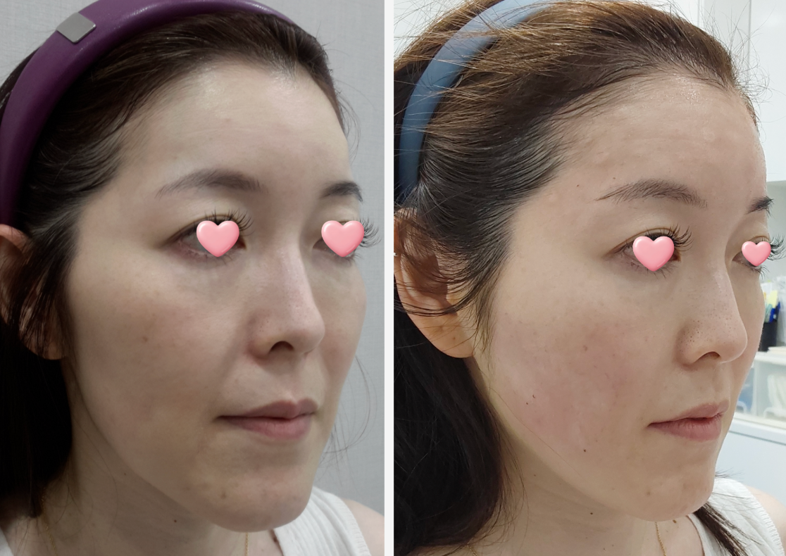 Anterior cheek filler before/after 1