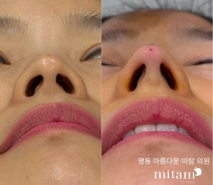 코 실리프팅 전후 2