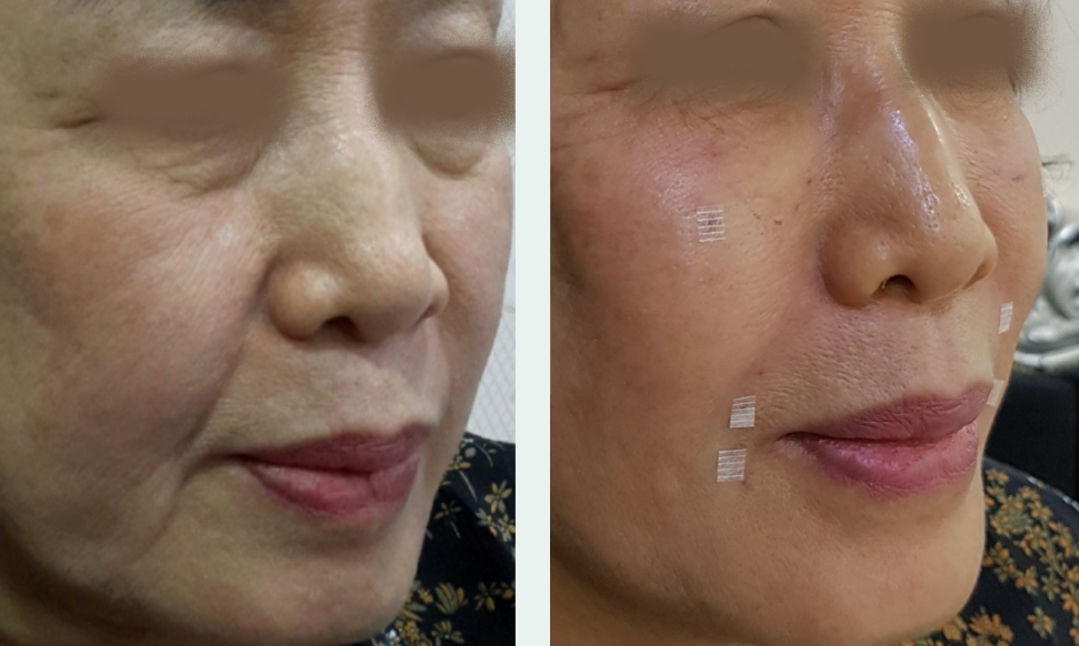 Nasolabial filler before/after 2