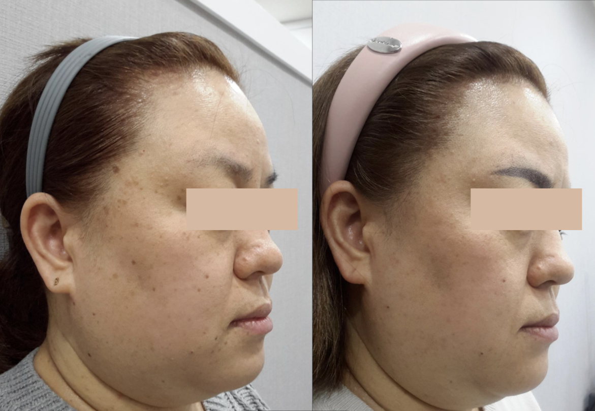 색소 제거 전후 사례 1